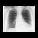 Hiatal hernia, chest radiograph: X-ray - Plain radiograph